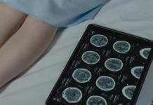 Porque Tiempo es Cerebro, llaman neurólogos a conocer los síntomas de los infartos cerebrales