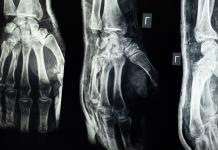 ¿Cómo están tus huesos? Uno de cada cinco adultos mayores en Jalisco tiene osteoporosis