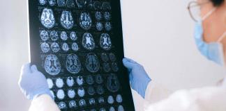 Alerta de salud: cada vez hay más tumores cerebrales y en personas más jóvenes