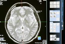 Una nueva herramienta basada en IA permitirá mejorar el diagnóstico de tumores cerebrales