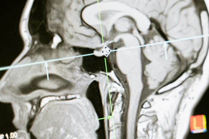 Una nueva herramienta basada en IA permitirá mejorar el diagnóstico de tumores cerebrales