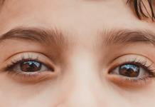 Conjuntivitis alérgica primera causa de problemas en los ojos de los niños