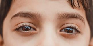Conjuntivitis alérgica primera causa de problemas en los ojos de los niños