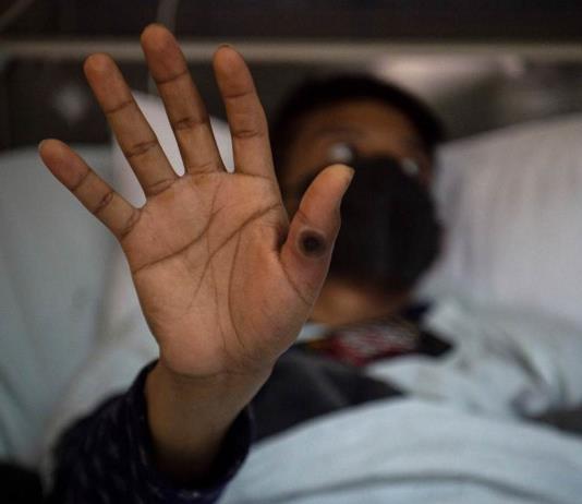 Jalisco registra 43 casos de Mpox en el primer semestre del año