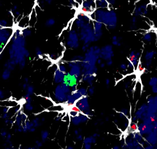 Identifican las células que facilitan la metástasis cerebral