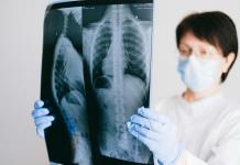 Expertos piden mejorar la detección temprana de hipertensión arterial pulmonar en México