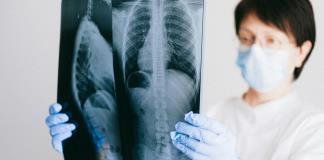 Expertos piden mejorar la detección temprana de hipertensión arterial pulmonar en México