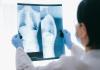 Asocian variantes genéticas raras con la supervivencia en la fibrosis pulmonar