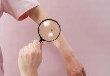 Los rayos UV causan 80% de los melanomas en el mundo, según una agencia de la OMS