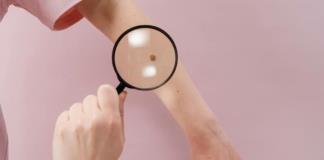 Los rayos UV causan 80% de los melanomas en el mundo, según una agencia de la OMS
