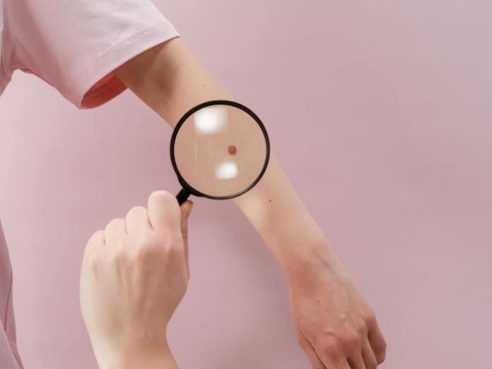 Los rayos UV causan 80% de los melanomas en el mundo, según una agencia de la OMS Los rayos UV causan 80% de los melanomas en el mundo, según una agencia de la OMS