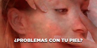 ¿Problemas con tu piel? - El Expresso de las 10 - Ma. 17 Junio 2025