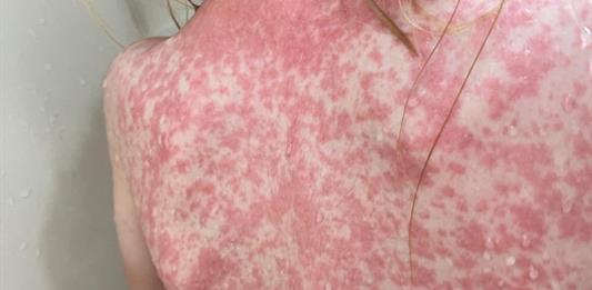 Sólo en la primera quincena de 2026, Jalisco registra 256 contagios de sarampión