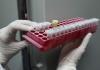 Cada 30 segundos en el mundo muere una persona por algún tipo de hepatitis