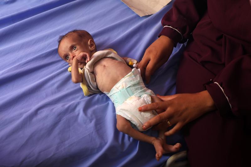 Más de 54.600 niños gazatíes sufren desnutrición severa, 12.800 muy grave Más de 54.600 niños gazatíes sufren desnutrición severa, 12.800 muy grave