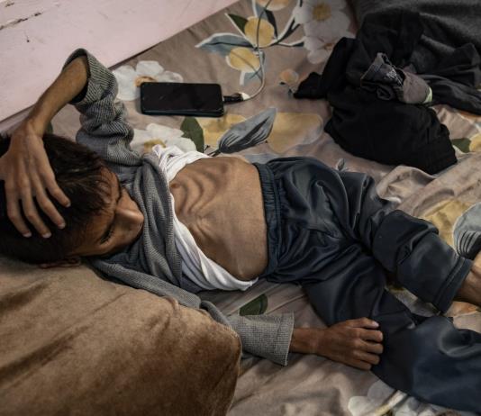 Más de 54.600 niños gazatíes sufren desnutrición severa, 12.800 muy grave