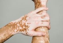 Científicos mexicanos descubren vínculo entre obesidad abdominal y vitiligo