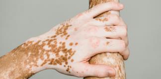 Científicos mexicanos descubren vínculo entre obesidad abdominal y vitiligo