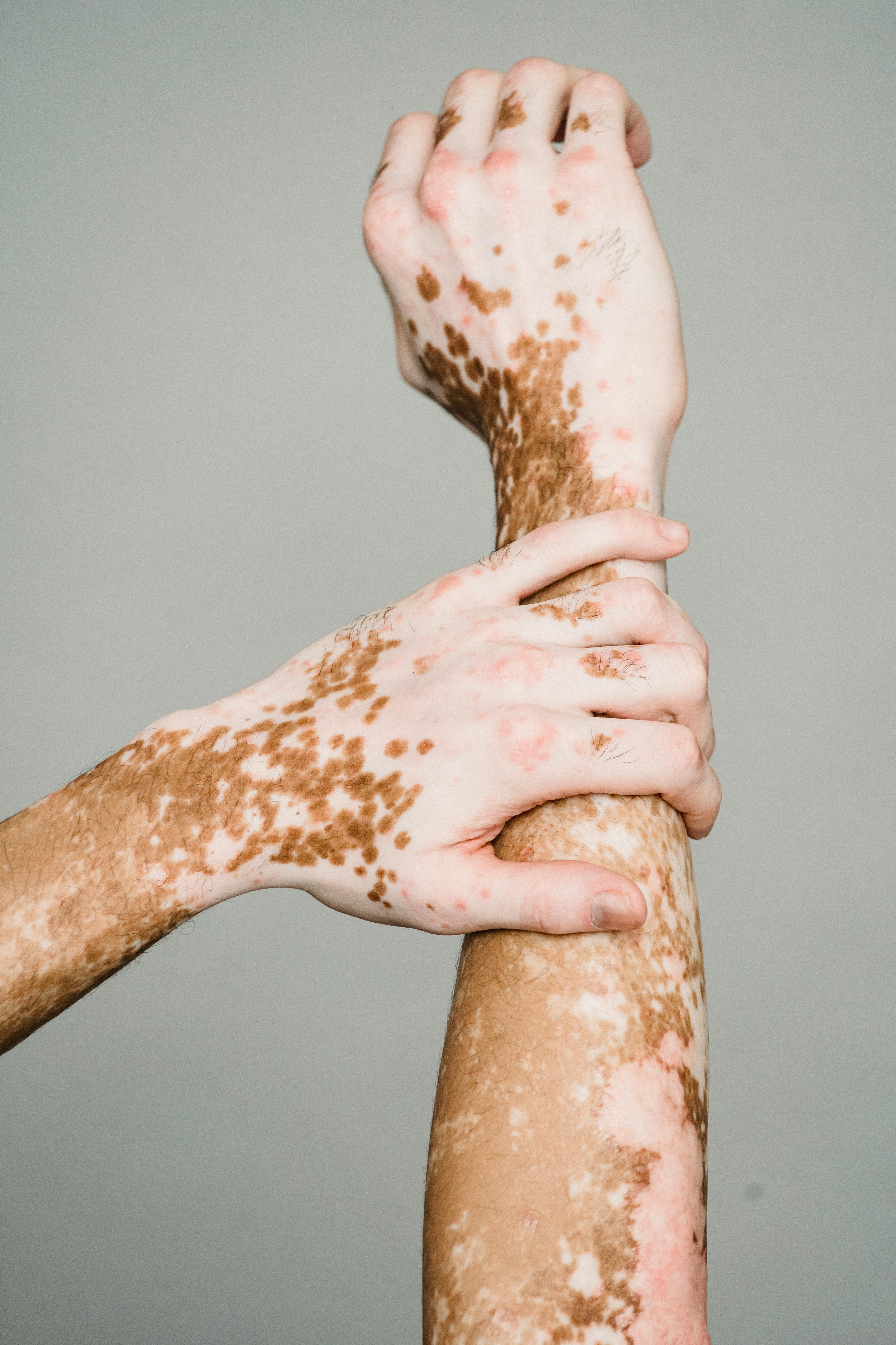 Científicos mexicanos descubren vínculo entre obesidad abdominal y vitiligo