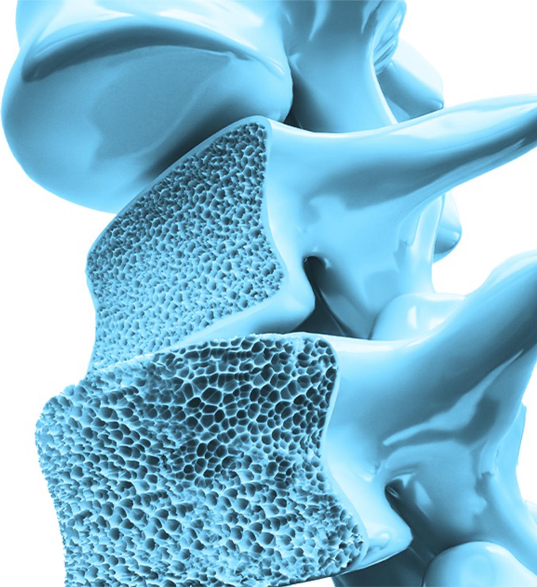 Osteoporosis: La enfermedad silenciosa que causa 70 fracturas por minuto en el mundo