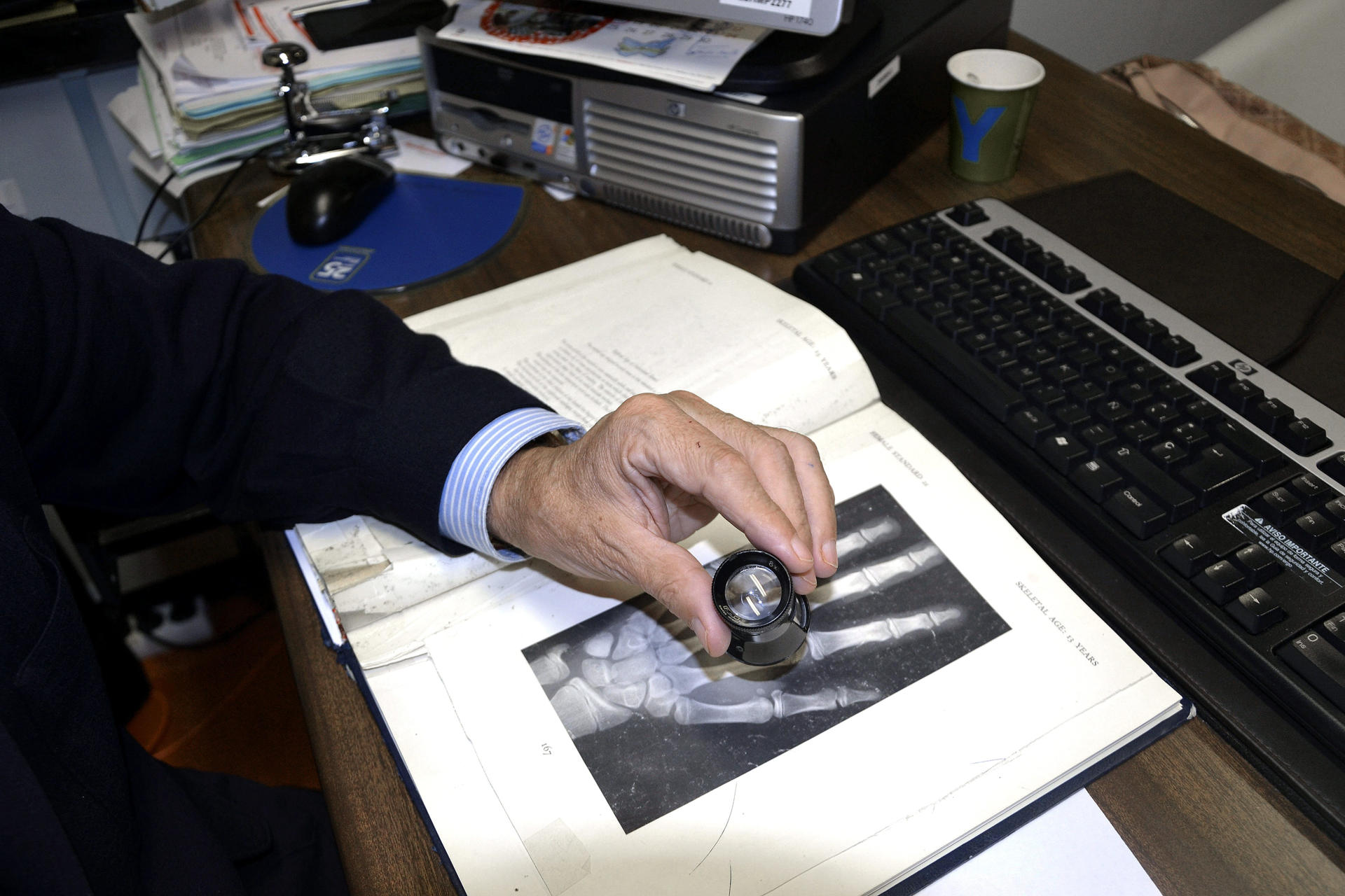 Unas 500 millones de personas en el mundo padecen osteoporosis sin saberlo