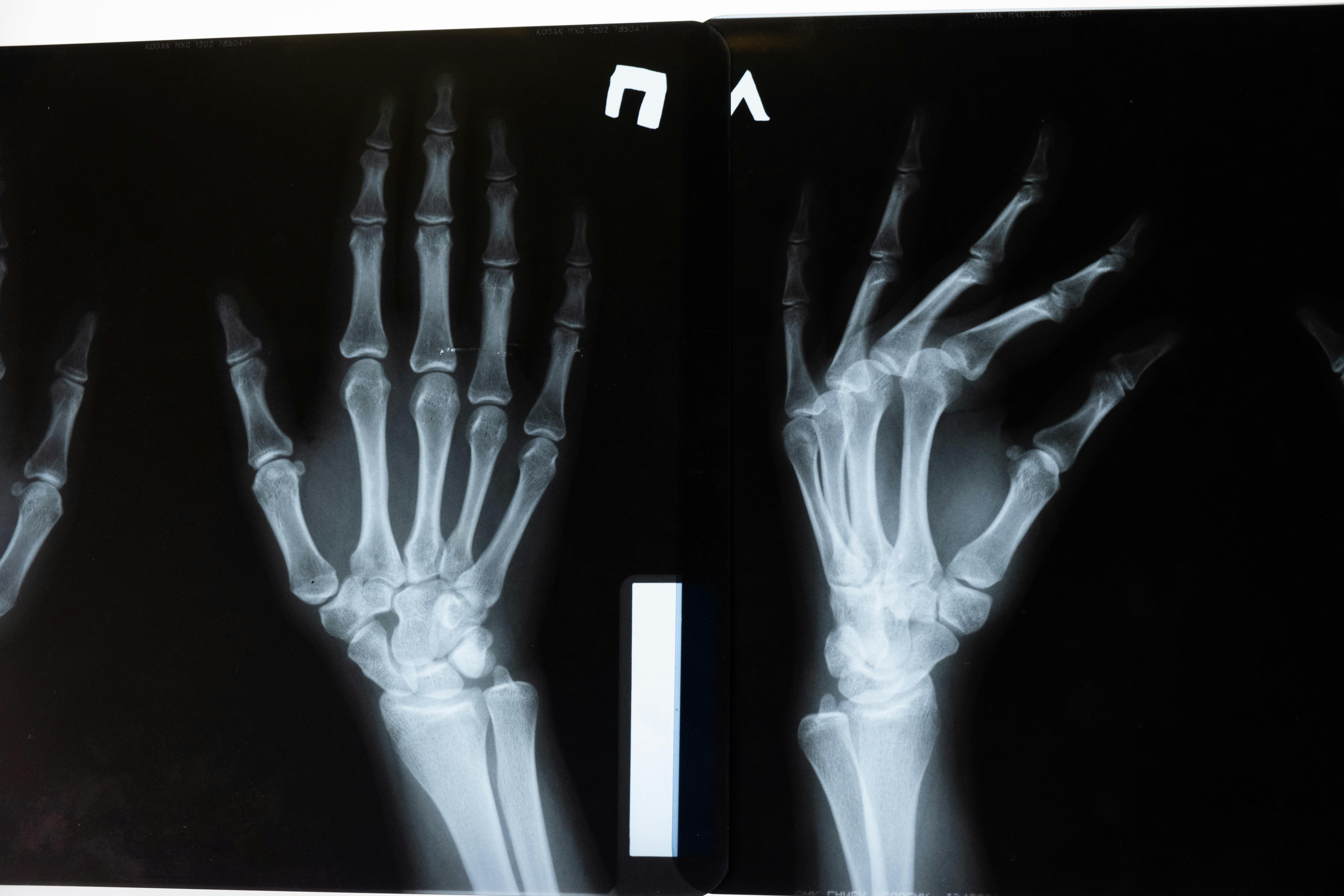 Osteoporosis: La enfermedad silenciosa que causa 70 fracturas por minuto en el mundo