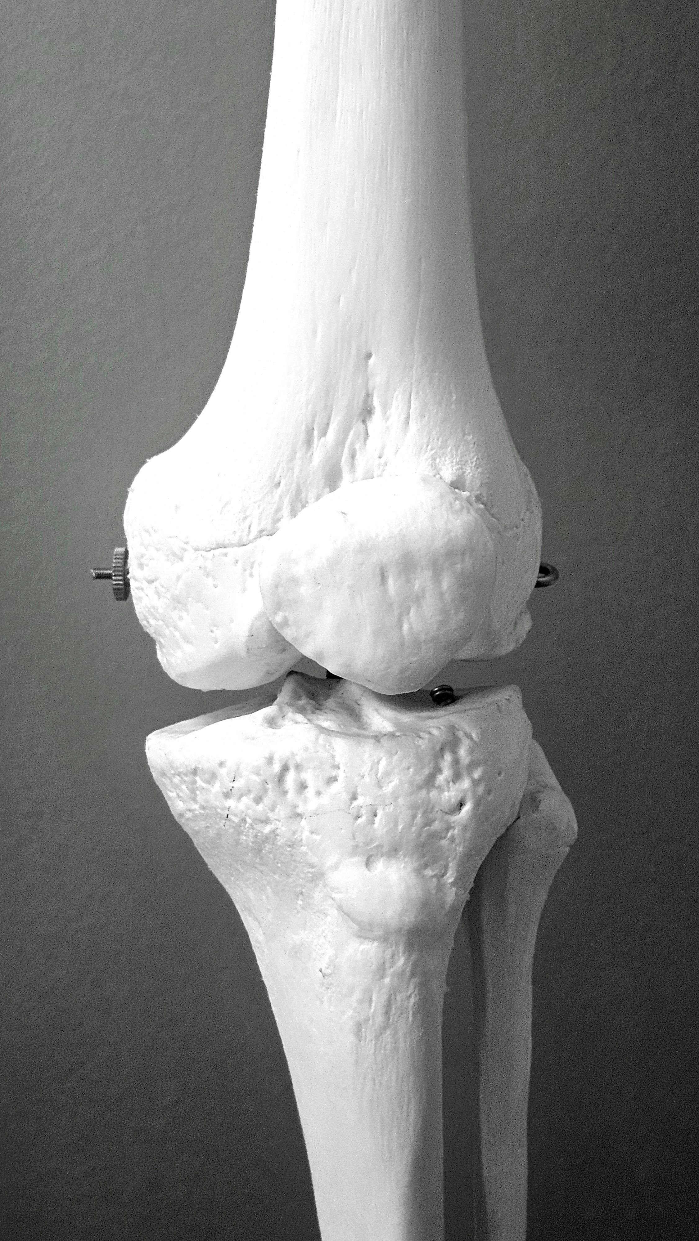 Osteoporosis: La enfermedad silenciosa que causa 70 fracturas por minuto en el mundo