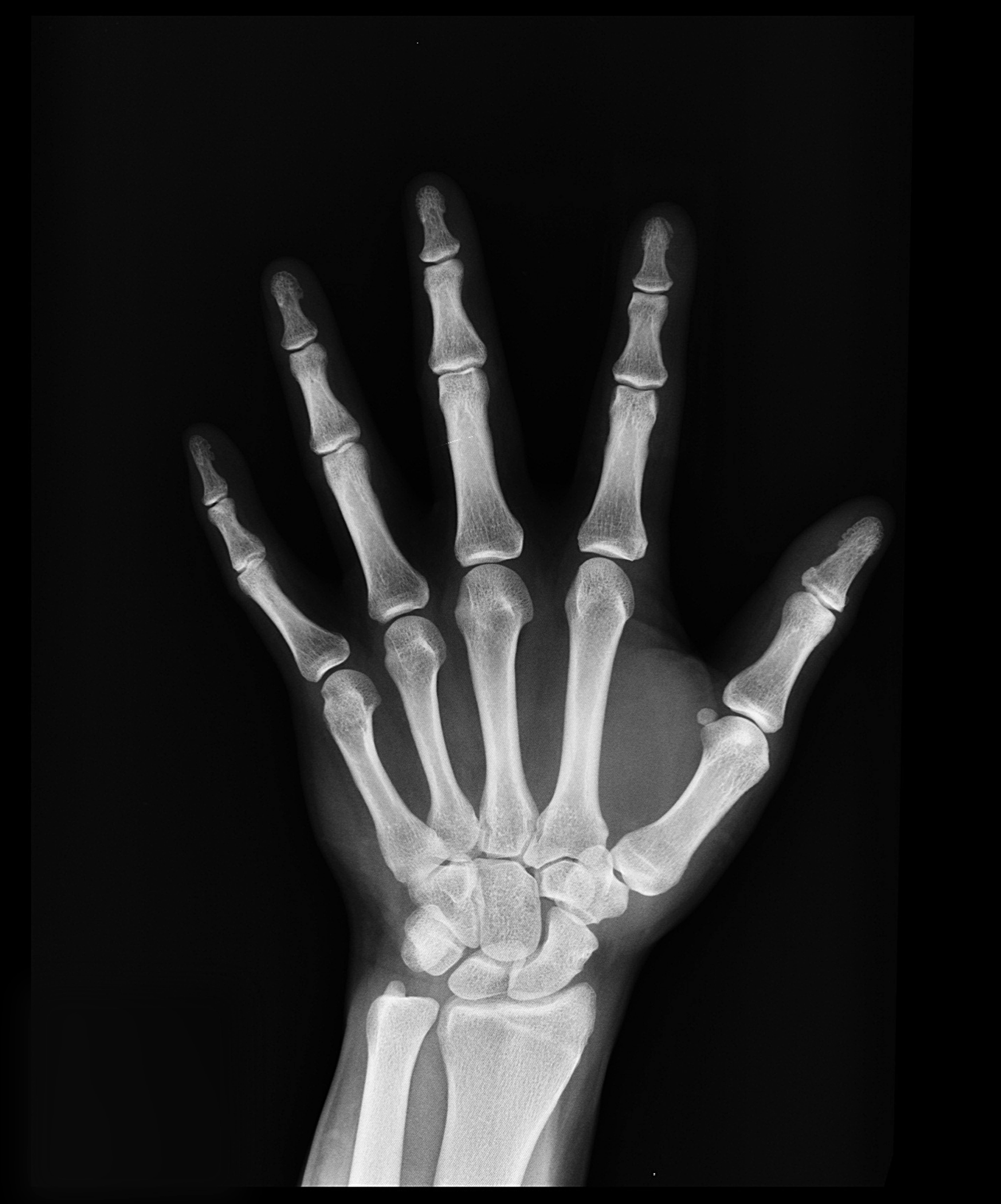 Osteoporosis: La enfermedad silenciosa que causa 70 fracturas por minuto en el mundo