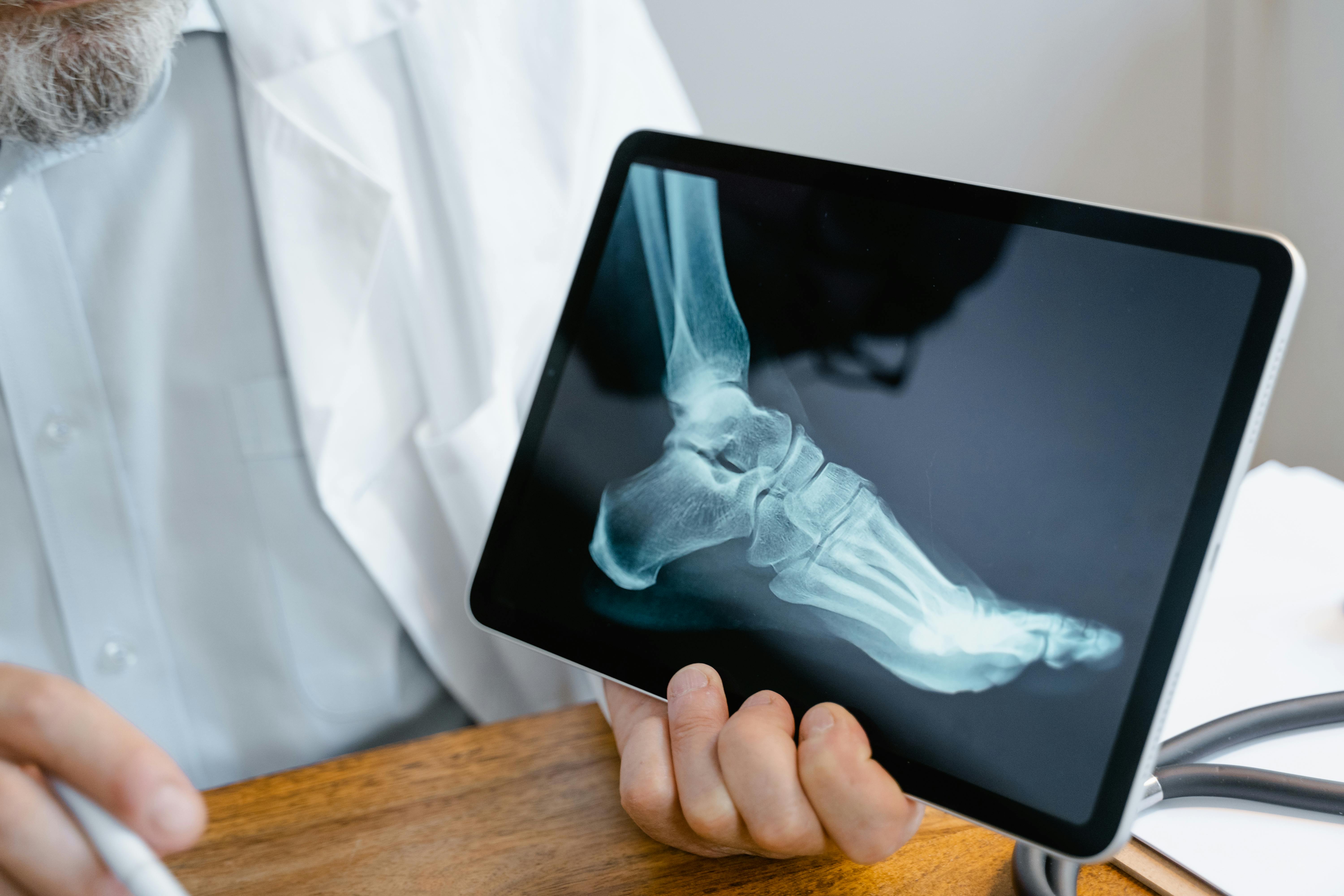 Osteoporosis: La enfermedad silenciosa que causa 70 fracturas por minuto en el mundo