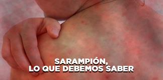 Sarampión, lo que debemos saber - El Expresso de las 10 - Lu. 27 Octubre 2025 Sarampión, lo que debemos saber - El Expresso de las 10 - Lu. 27 Octubre 2025