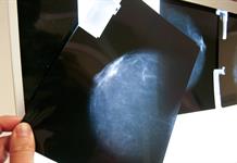 Expertos alertan sobre la falta de registros de cáncer de mama en América Latina Expertos alertan sobre la falta de registros de cáncer de mama en América Latina