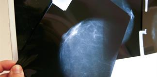 Expertos alertan sobre la falta de registros de cáncer de mama en América Latina Expertos alertan sobre la falta de registros de cáncer de mama en América Latina