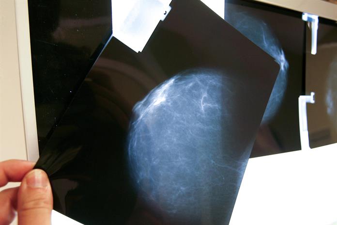 Expertos alertan sobre la falta de registros de cáncer de mama en América Latina Expertos alertan sobre la falta de registros de cáncer de mama en América Latina