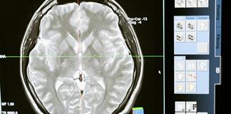 Neuróloga advierte: el sarampión puede dañar al cerebro Neuróloga advierte: el sarampión puede dañar al cerebro