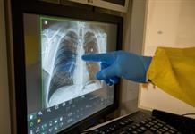 Diagnóstico temprano y prevención, pilares para mejorar salud pulmonar en América Latina Diagnóstico temprano y prevención, pilares para mejorar salud pulmonar en América Latina