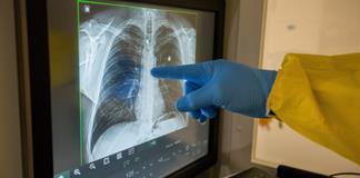 Diagnóstico temprano y prevención, pilares para mejorar salud pulmonar en América Latina Diagnóstico temprano y prevención, pilares para mejorar salud pulmonar en América Latina