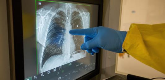 Diagnóstico temprano y prevención, pilares para mejorar salud pulmonar en América Latina