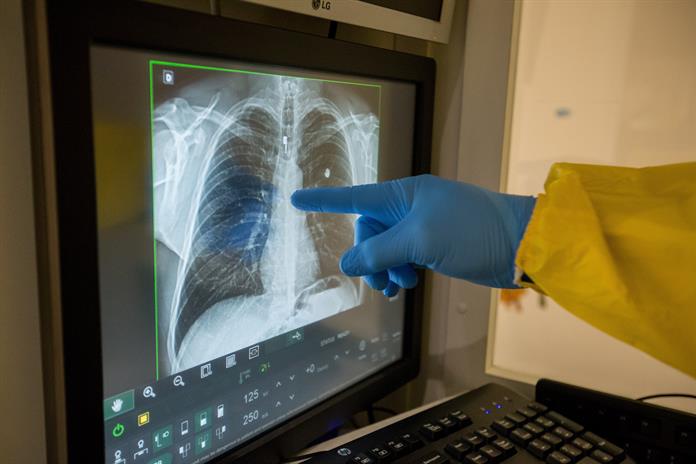 Diagnóstico temprano y prevención, pilares para mejorar salud pulmonar en América Latina Diagnóstico temprano y prevención, pilares para mejorar salud pulmonar en América Latina