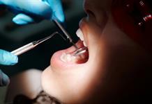 Un grupo de países acuerda prohibir el mercurio en rellenos dentales para 2034 Un grupo de países acuerda prohibir el mercurio en rellenos dentales para 2034