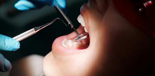 Un grupo de países acuerda prohibir el mercurio en rellenos dentales para 2034