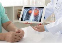 Analizan la relación entre los contaminantes del aire y los subtipos de cáncer de pulmón