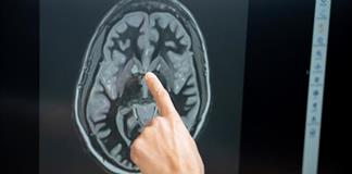 Tirzepatida reduce deseo de comer según investigación Tirzepatida reduce deseo de comer según investigación