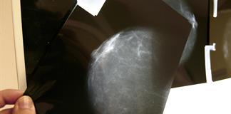 Relacionan la alta densidad mamaria con tumores de peor pronóstico