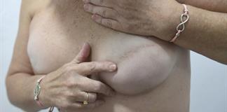 La angustia de las mujeres con cáncer de mama, olvidadas por el sistema de salud en Andalucía