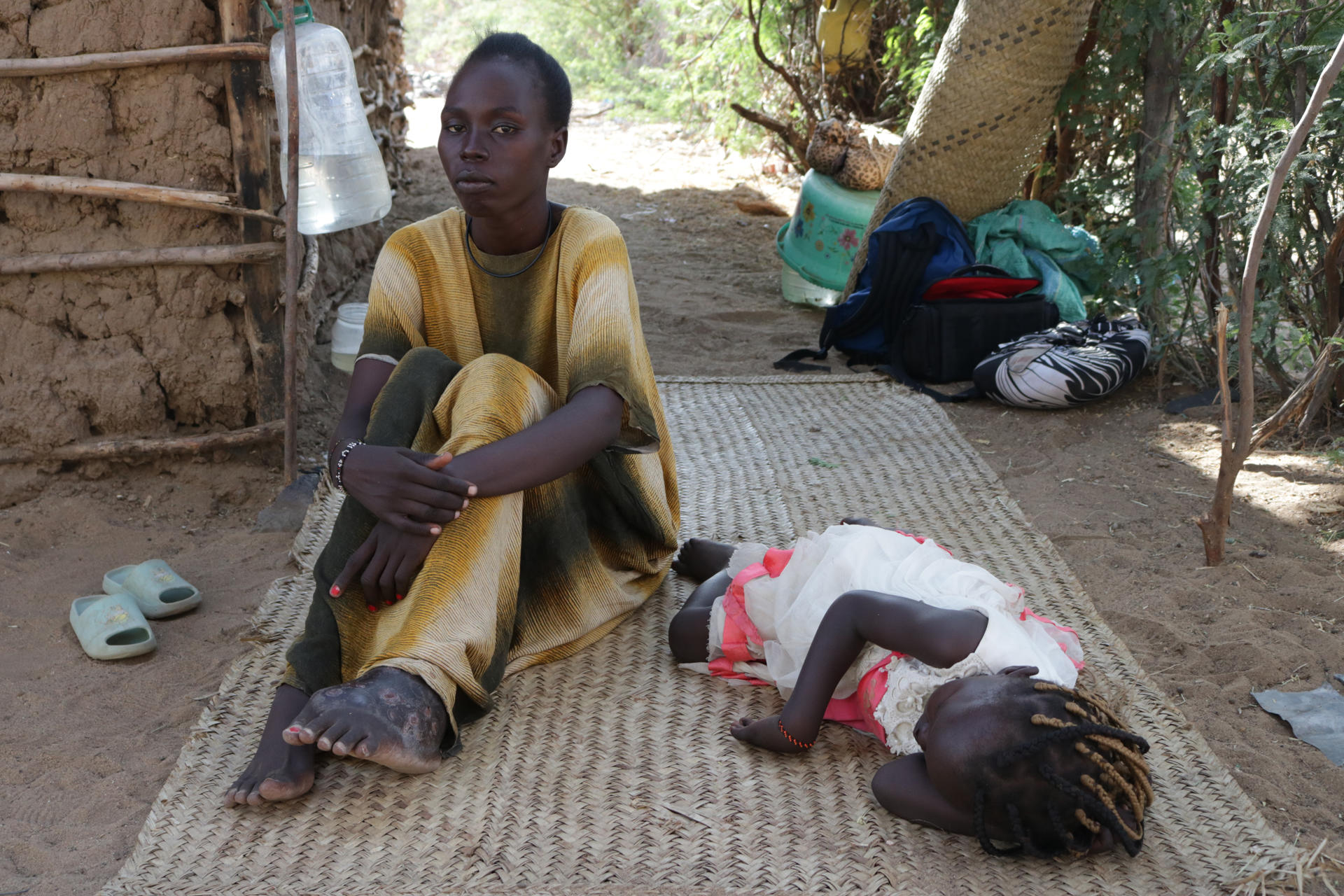 Como si me comiera desde dentro: la enfermedad que ataca los huesos en el norte de Kenia