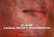 El Acné: causas, mitos y tratamientos - El Expresso de las 10 - Ma. 03 Febrero 2026