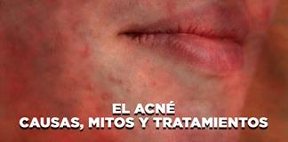 El Acn&eacute;: causas, mitos y tratamientos - El Expresso de las 10 - Ma. 03 Febrero 2026