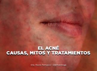El Acné: causas, mitos y tratamientos - El Expresso de las 10 - Ma. 03 Febrero 2026 El Acné: causas, mitos y tratamientos - El Expresso de las 10 - Ma. 03 Febrero 2026