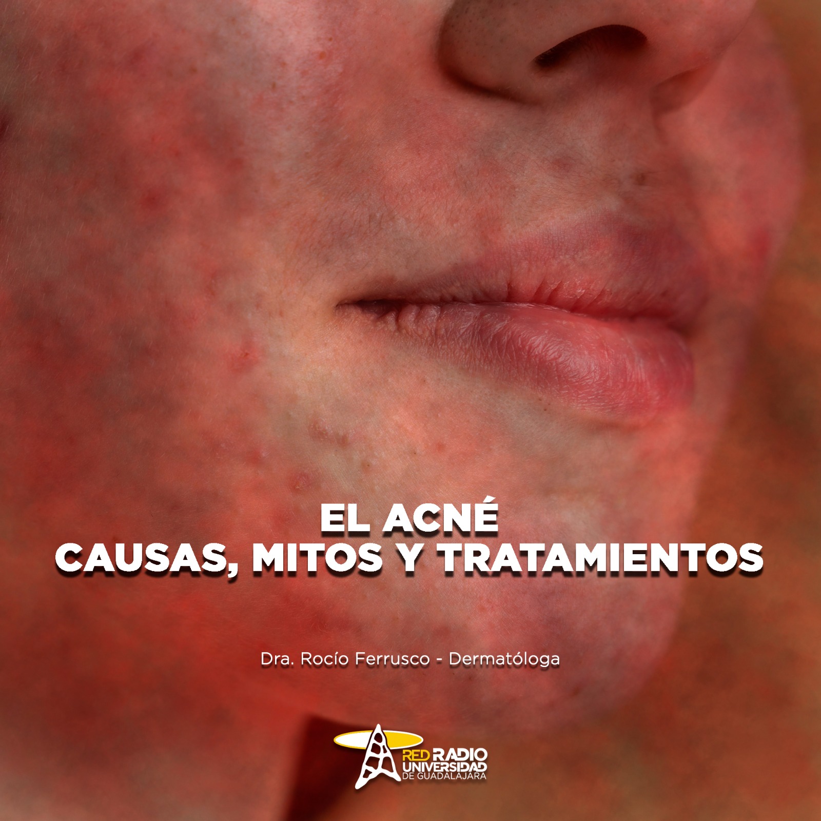 El Acné: causas, mitos y tratamientos - El Expresso de las 10 - Ma. 03 Febrero 2026 El Acné: causas, mitos y tratamientos - El Expresso de las 10 - Ma. 03 Febrero 2026