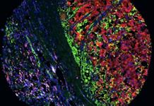 Una estrategia experimental reduce la metástasis del melanoma y mejora la inmunoterapia